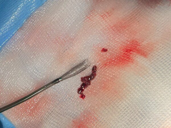 image caption: A brain clot removed with Ceretrieve’s device