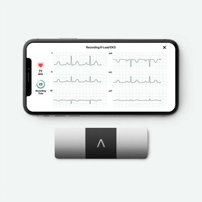 KardiaMobile 6L 6-lead EKG view