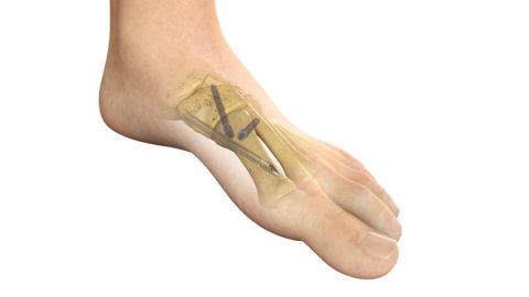 Stryker's PROstep® MIS Lapidus is a new internal fixation system intended for treating bunions using a minimally invasive surgical reduction of hallux valgus deformity and subsequent fusion of the first metatarsal cuneiform joint. 